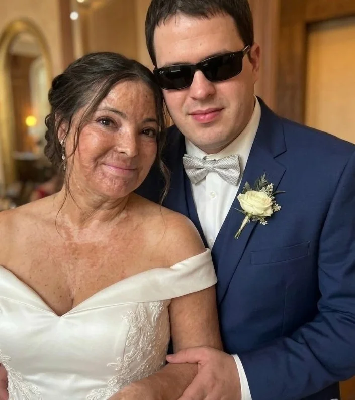 I Married a Blind Man Believing He’d Never See the Burn Scars That Ruined My Confidence